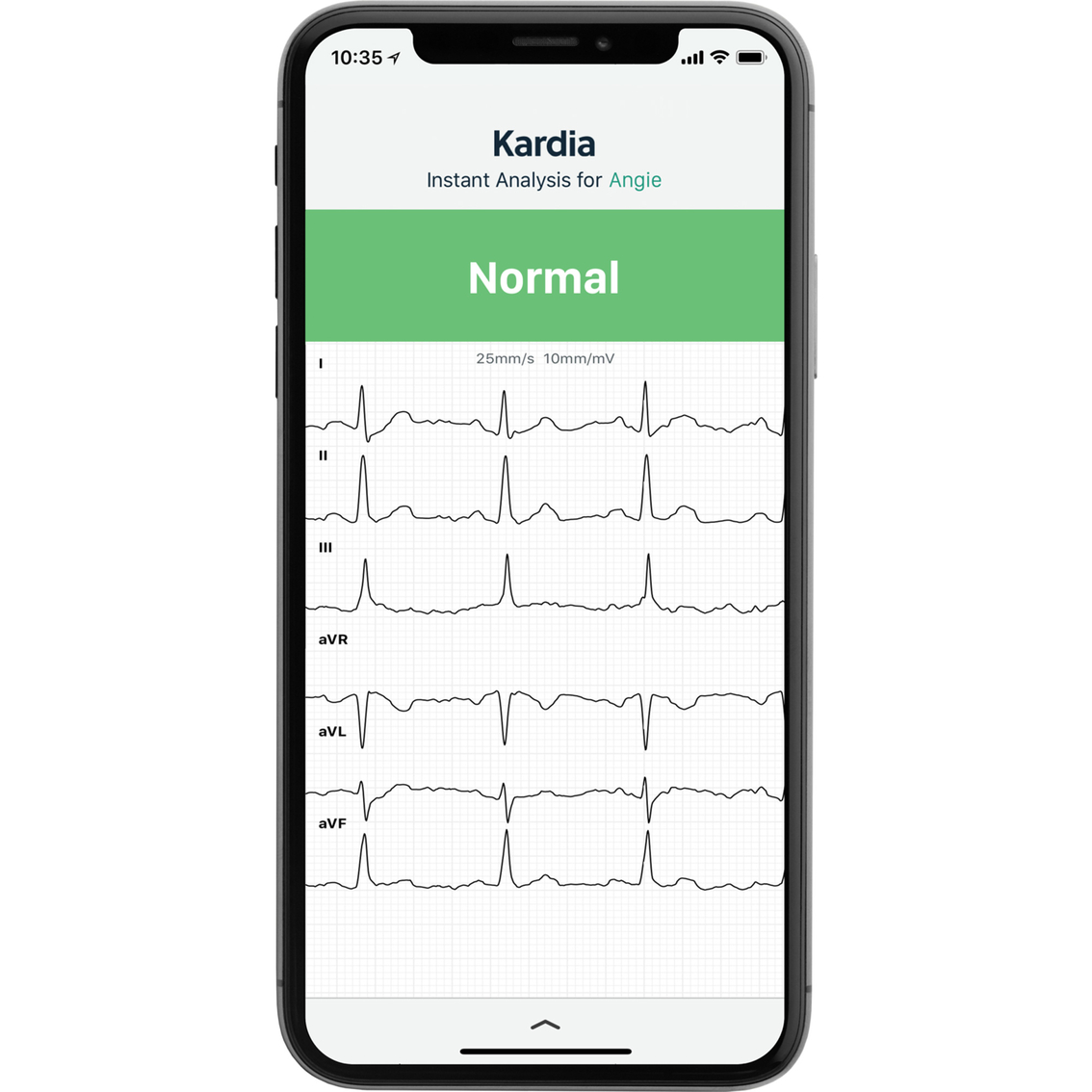 KardiaMobile 6-Lead Personal ECG Monitor - Six Views of The Heart - Detects  AF and Irregular Arrhythmias - Instant Results in 30 Seconds - Works with  Most Smartphones : : Sports & Outdoors